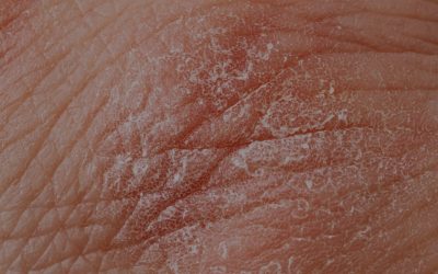 Eczema: Definition and Treatment Options