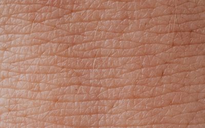 Treatment of Hives