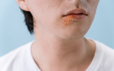 Acyclovir vs. Valacyclovir