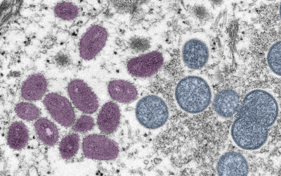 How Contagious Is Monkeypox?